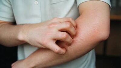Hava sıcaklıklarının değişmesiyle birlikte ciltte ortaya çıkan kaşıntı şikâyetleri, hem